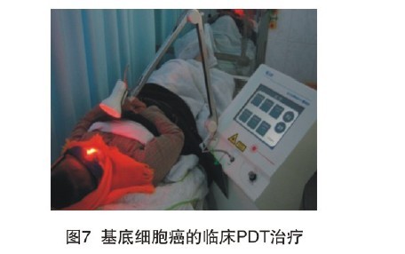光动力学疗法的现状与未来
