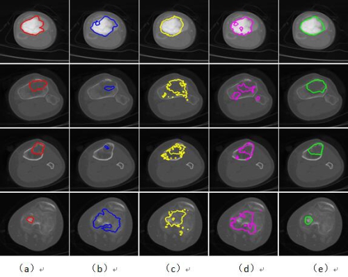 苏州医工所在基于深度学习的肿瘤图像分割研究中获得进展