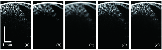 不同滤波方法的对比。(a)原始OCT图像;(b)中值滤波;(c)均值滤波;(d)高斯滤波;(e)维纳滤波
