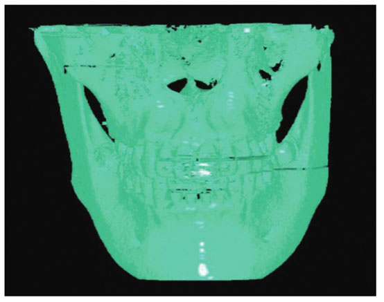 用MicroDicom Viewer对口腔CBCT数据进行重建的效果图