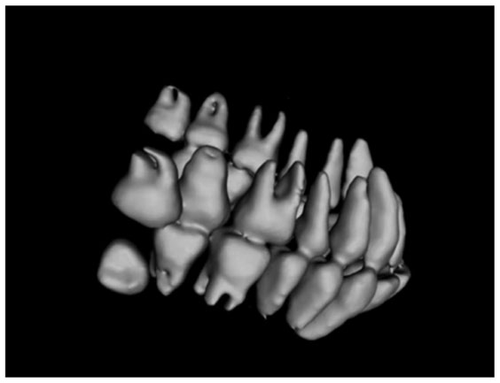 采用本文算法对口腔CBCT数据进行三维重建的效果