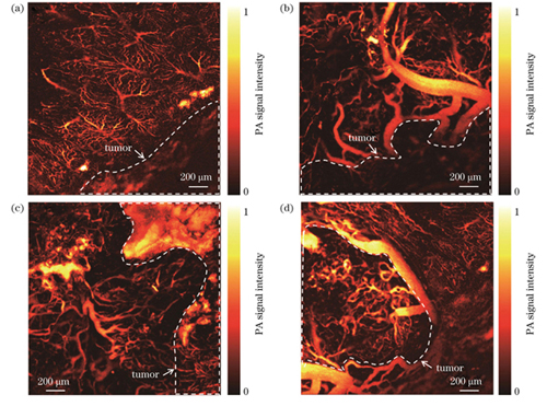 HCC小鼠肝脏肿瘤微血管结构的光声显微成像。(a)癌旁肝小叶结构;(b)(c)癌旁血管结构;(d)肿瘤中心血管