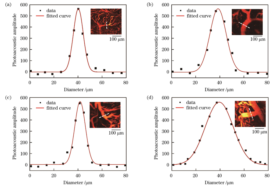 HCC微血管直径定量分析。(a)癌旁肝小叶静脉分支直径;(b)(c)癌旁血管直径;(d)肿瘤中心血管直径