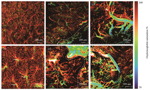 正常肝脏血管和肿瘤微血管的氧饱和度分布。(a)正常肝脏血管氧气代谢;(b)癌旁肝小叶氧气代谢;(d)正常肝小叶氧气代谢;(c)(e)癌旁血管的氧气代谢;(f)肿瘤中心血管氧气代谢
