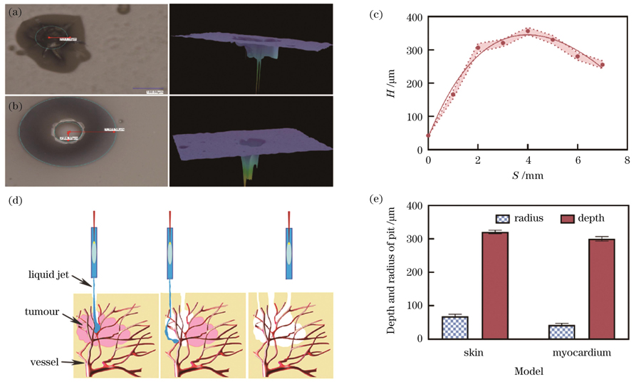 激光作用于琼脂糖凝胶模型的效果。(a)凹坑的平面图和三维深度图(SS≥2 mm);(c)琼脂糖凝胶模型与喷嘴间的距离S对凹坑深度H的影响;(d)激光诱导微射流去除肿瘤示意图;(e)不同生物组织模型所产生的凹坑的半径和深度