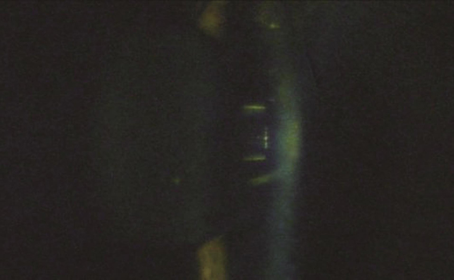 前房深度测量结果